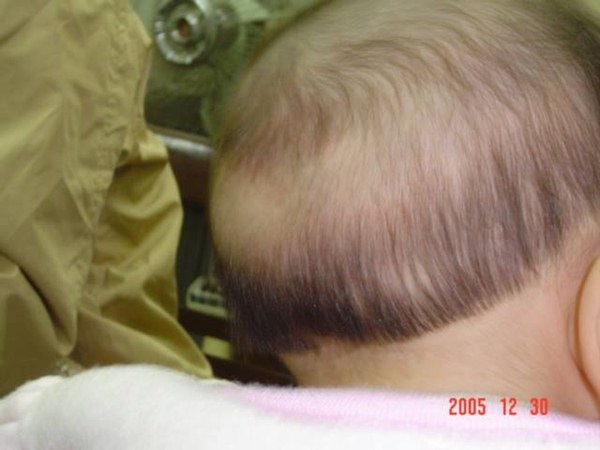 cach dieu tri rung toc vanh khan o tre nho2 Cách điều trị rụng tóc vành khăn ở trẻ nhỏ đơn giản ngay tại nhà